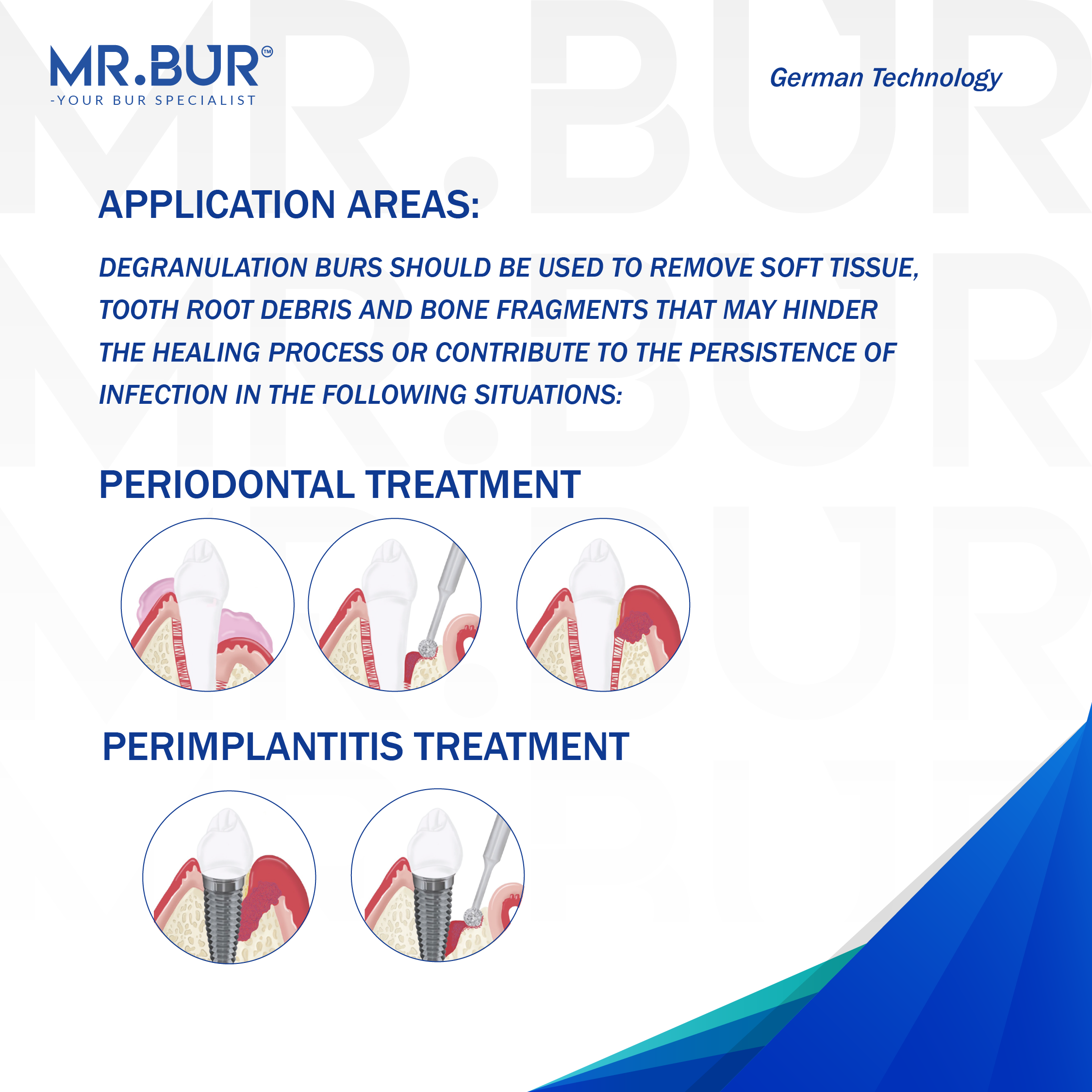 Advertisement for MR.BUR dental tools with application areas for periodontal and perimplantitis treatment on a white background.