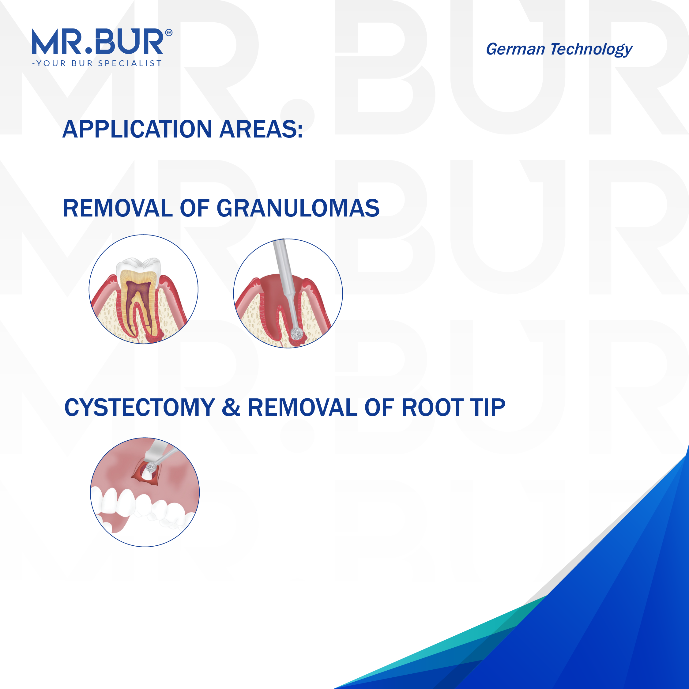 Advertisement for MR.BUR dental tool with application areas for removal of granulomas and cystectomy & removal of root tip on a white background