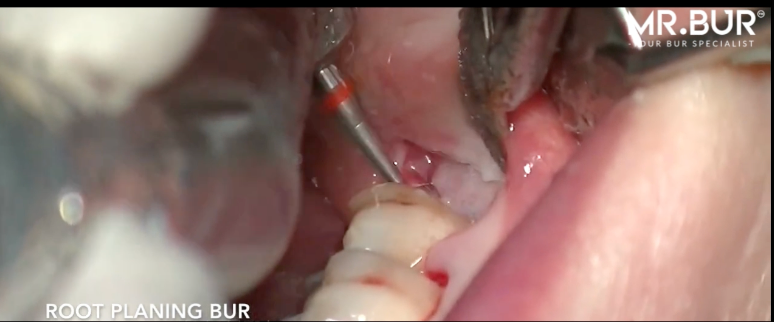 Mr. Bur Periodontal Root Planing Bur ensures precise, efficient removal of calculus and infected cementum, enhancing periodontal health and tissue healing.